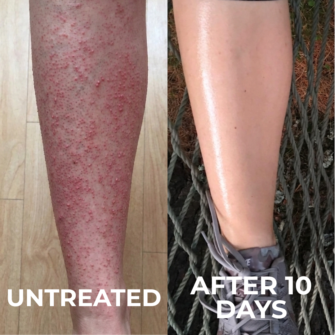 Triple-Acid Complex for Smoothing Rough Bumpy Skin