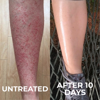Triple-Acid Complex for Smoothing Rough Bumpy Skin