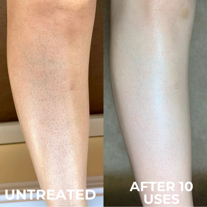 Triple-Acid Complex for Smoothing Rough Bumpy Skin