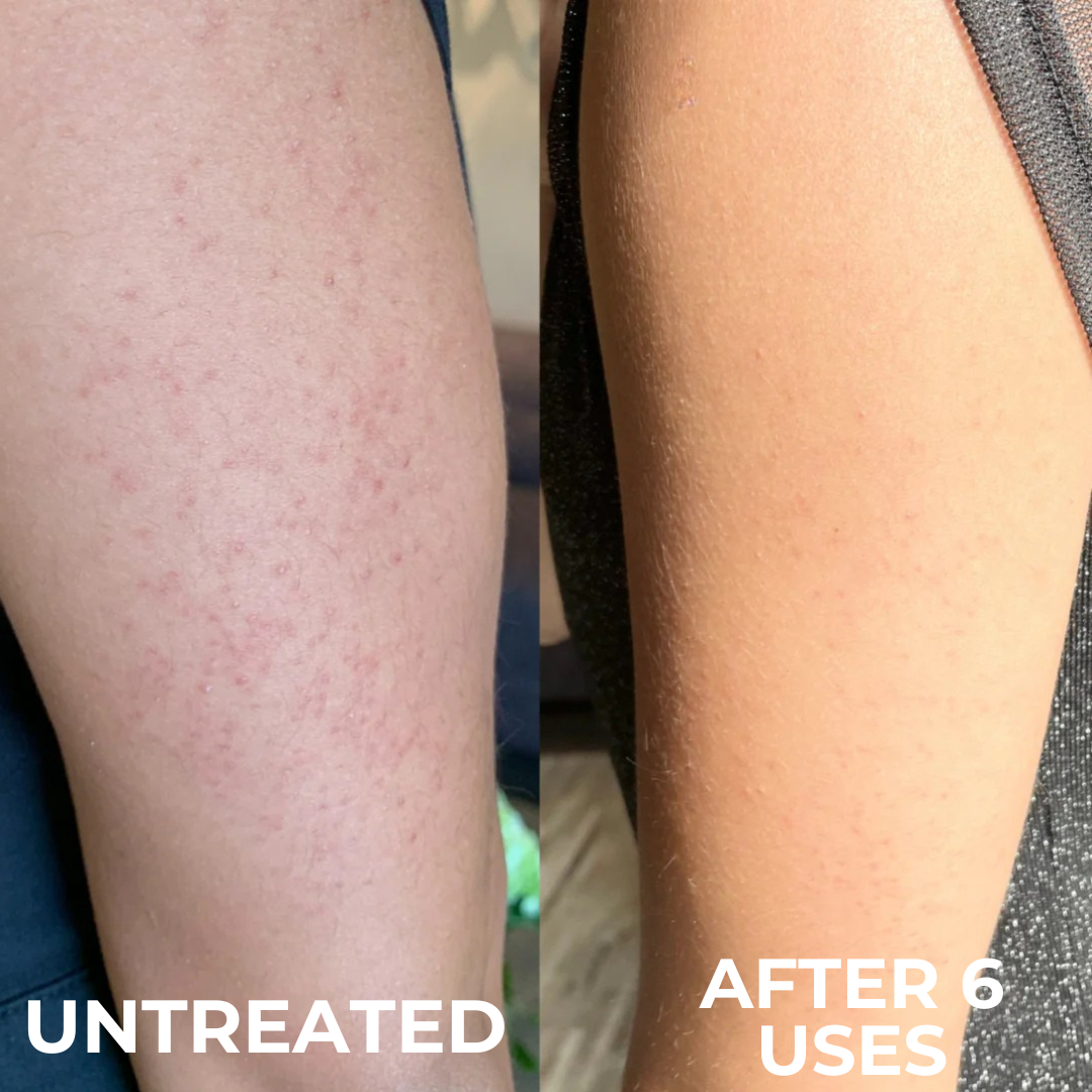 Triple-Acid Complex for Smoothing Rough Bumpy Skin